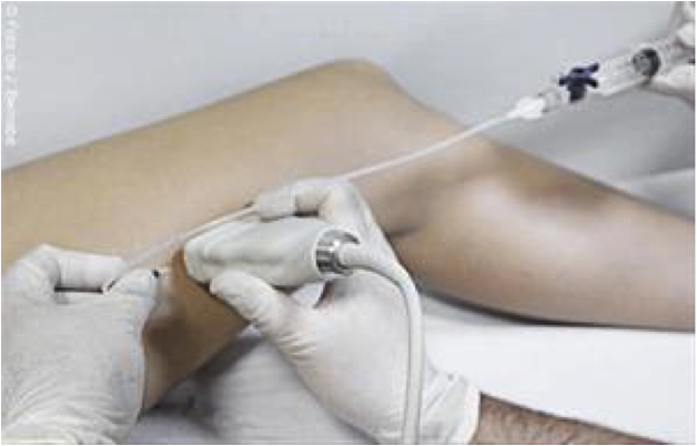Reparadas veias das pernas as das válvulas podem ser